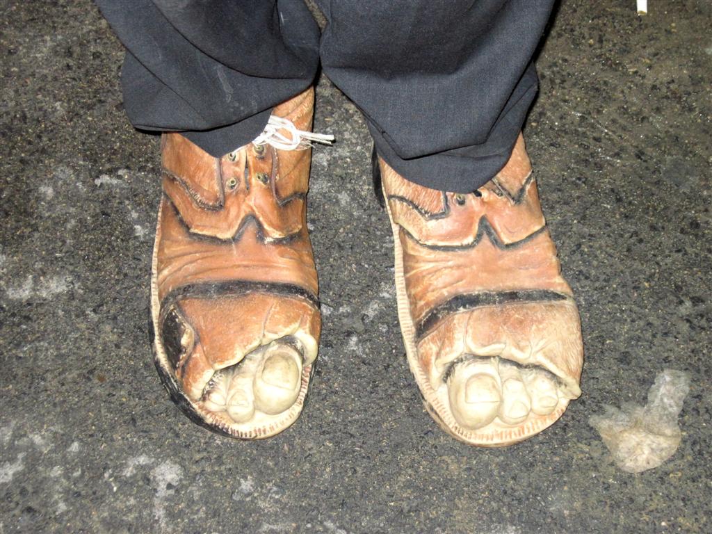 זקוק לתרומת נעליים וטיפול דחוף