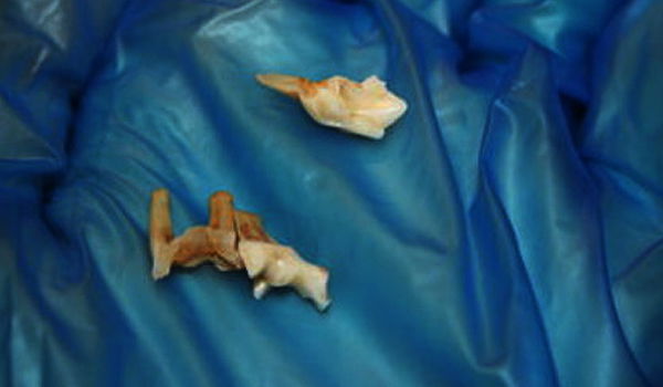 השן שנמצאה בשקית