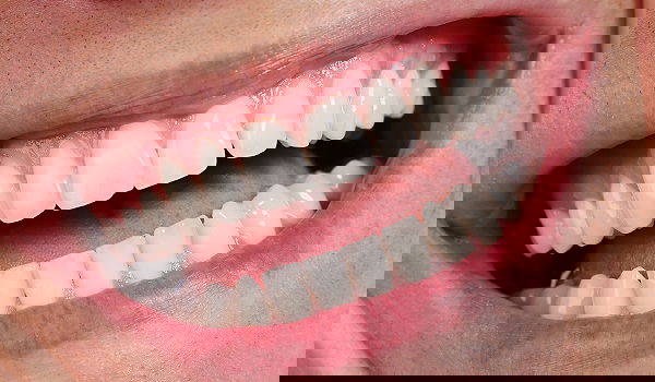 השיטות הטבעיות לשמור על השיניים