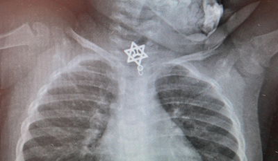 פעוטה בת שנתיים בלעה תליון "חי" וניצלה