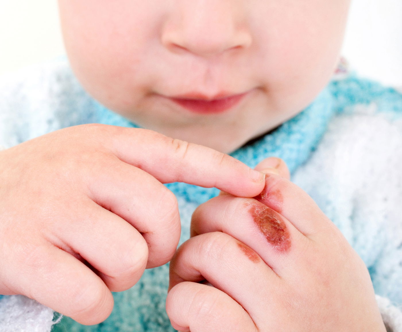 כך תמנעו את האסון הבא ותגנו על ילדכם מפני כוויות