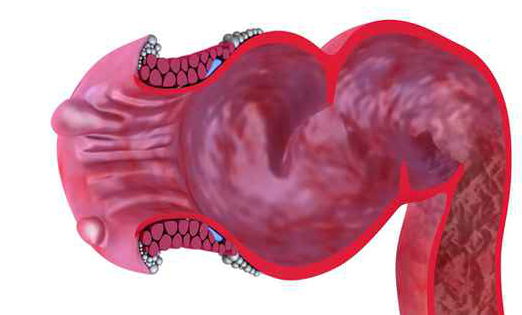 מהי מחלת הקרוהן וכיצד יש לטפל בה