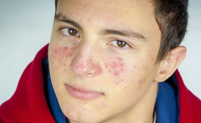 ילד מתבגר? טיפול ראשוני לפצעי ה'אקנה'