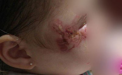 הפעוטה החרדית התעוררה עם חבלות קשות על פניה