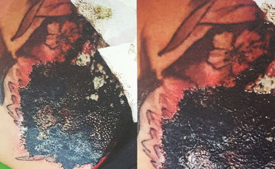 אברכים שחזרו בתשובה הסירו קעקועים ואושפזו