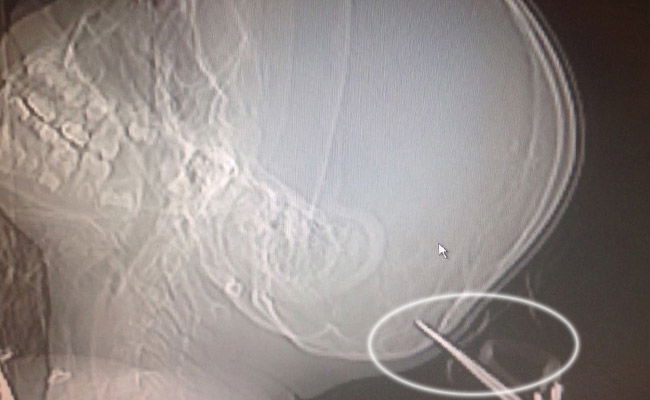 המספריים נעוצות בראש