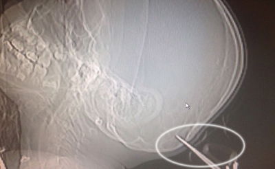 המספריים נעוצות בראש