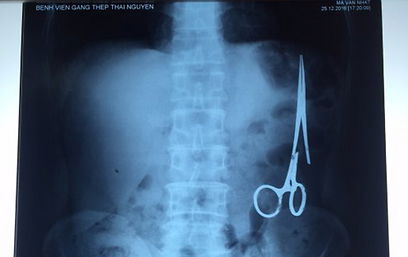 המלקחיים בצילום הרנטגן