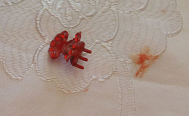 הסיכה שהפעוטה בלעה