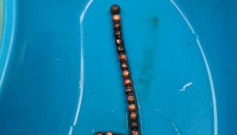 שרשרת המגנטים שהוצאה מבטן התינוק