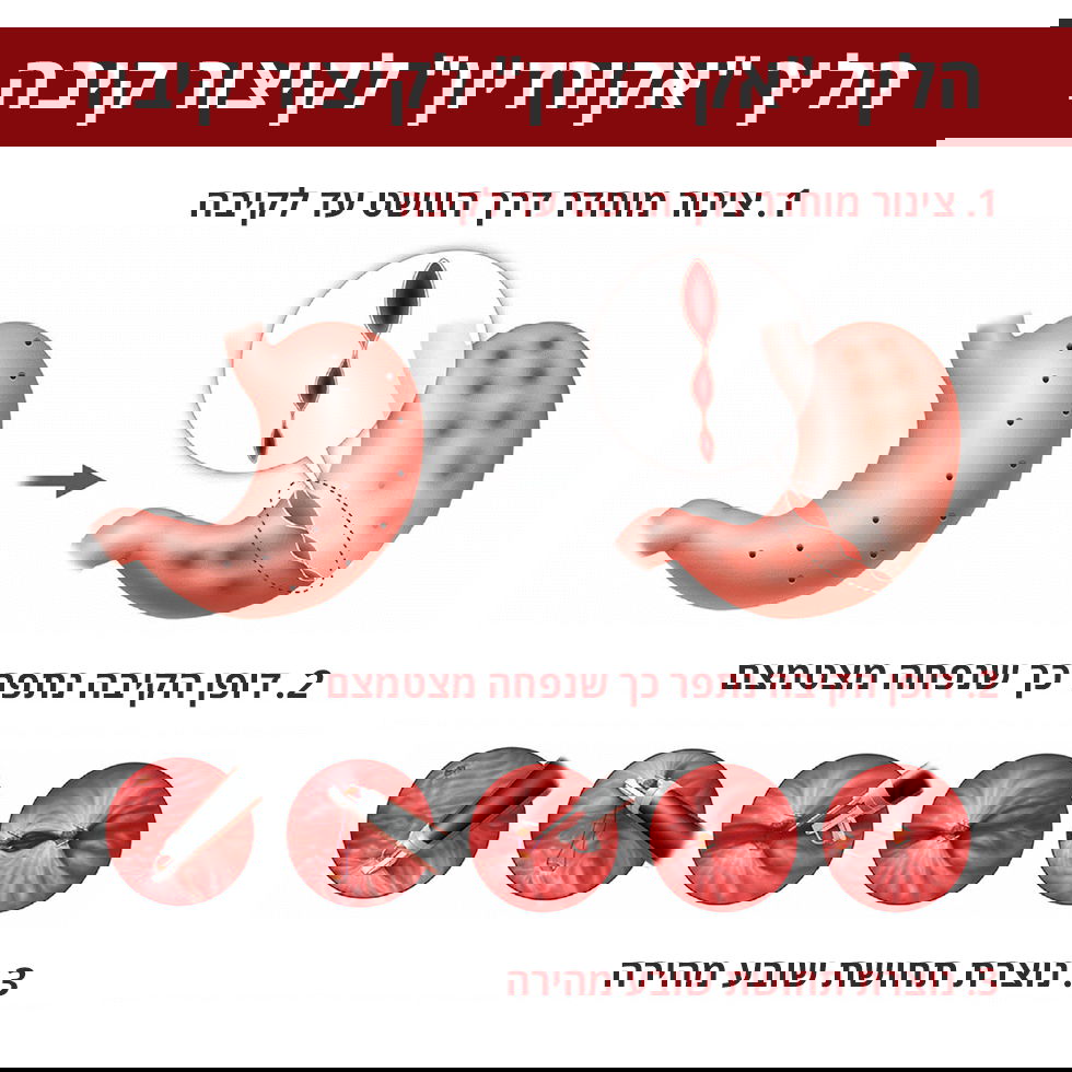 "אקורדיון" - תהליך קיצור קיבה הבטוח ביותר