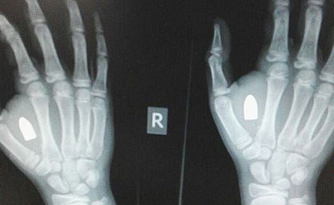 הקליע בכף ידו של הילד