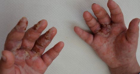 ידי הילדה שנפגעו