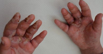 ידי הילדה שנפגעו