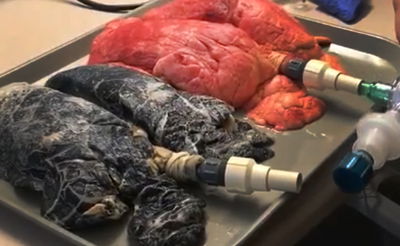 הסרטון שמזעזע מיליוני מעשנים מכל העולם: ככה נראות ריאות של מעשן