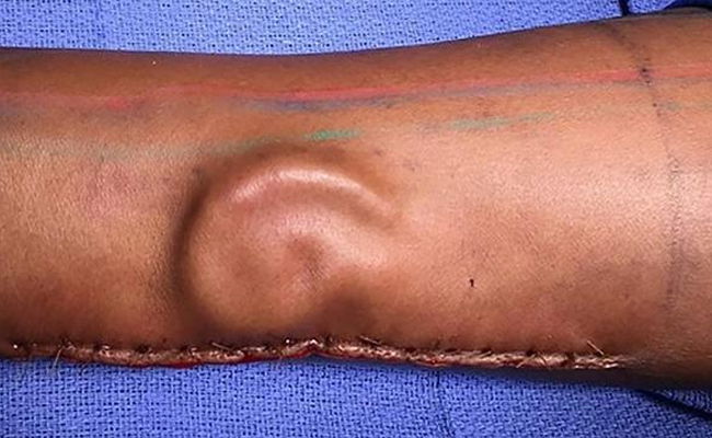 האוזן שהוצמחה על היד