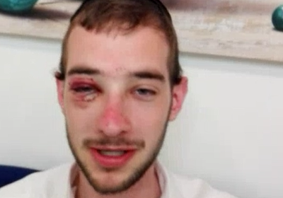 עדות קשה: השוטר ריסק את המשקפיים שלי לתוך העיניים