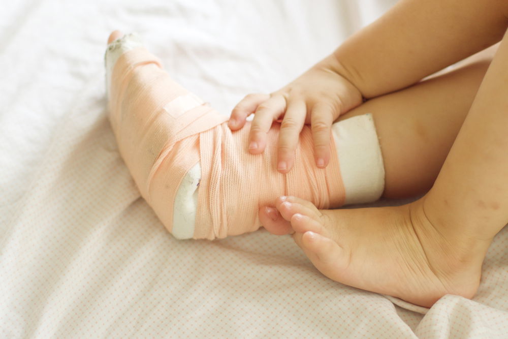 שבר ברגל. אילוסטרציה