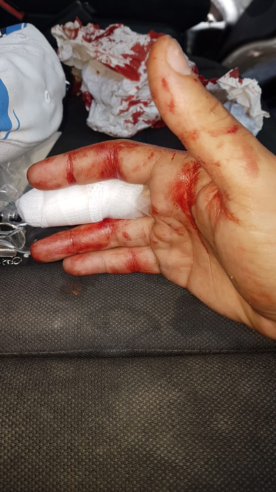 ידו הפצועה של המחלץ