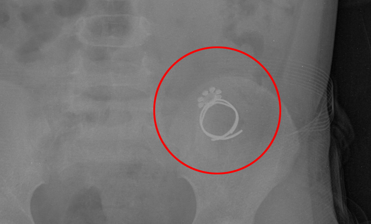 הטבעת בבטנה של הילדה