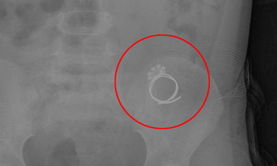 הטבעת בבטנה של הילדה