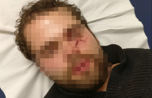 יוגב בורשטיין לאחר התקיפה