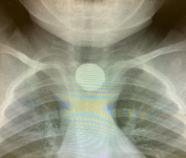 נס: בטריה קטנה התגלתה בוושט של התינוק