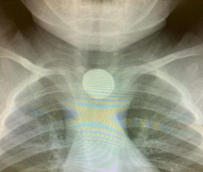 נס: בטריה קטנה התגלתה בוושט של התינוק