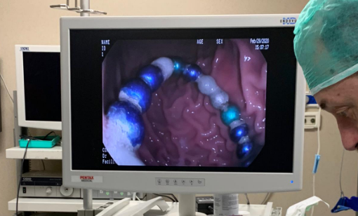 פעוטה בת שנה וחצי בלעה מגנטים ונותחה