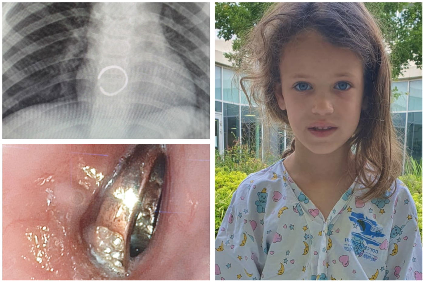 טבעת משובצת אבני חן נשלפה מגופה של ילדה בת 6