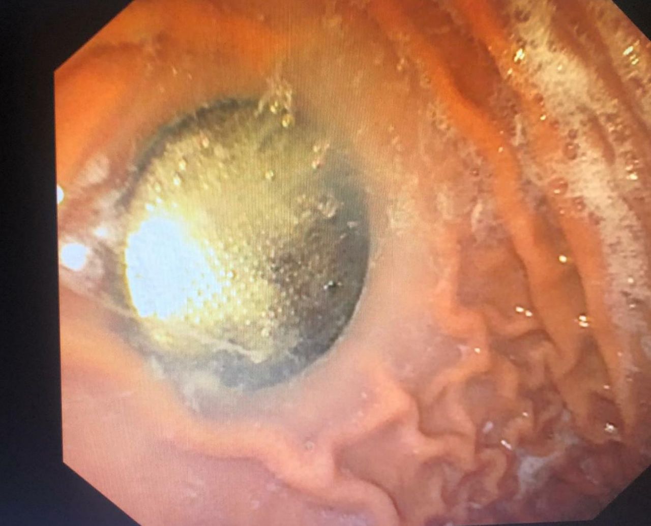 משתעממים בסגר? הילדים בולעים סוללות