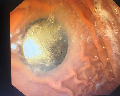 משתעממים בסגר? הילדים בולעים סוללות