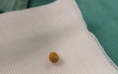 הפופקורן שחולץ מריאות הילדה