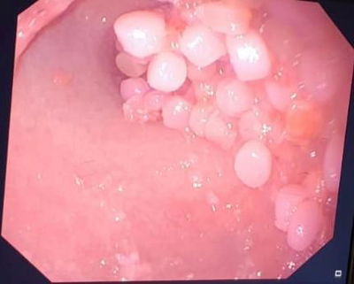 הכדורי ג'לי בקיבת התינוק