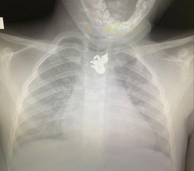 הטבעת בוושט