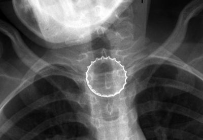 הפקק בתוך הוושט