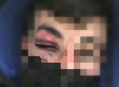 צעיר מוכה בפניו. אילוסטרציה. למצולם אין קשר לנאמר בכתבה