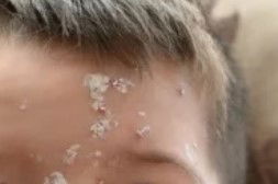 אבעבועות בפנים של ילד