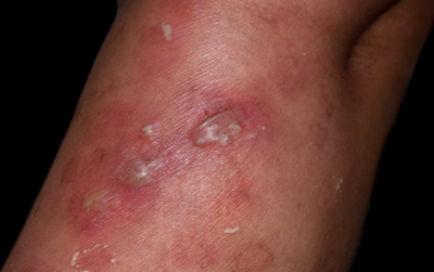 אבעבועות הקוף עברו מוטציה? זו התשובה של ארגון הבריאות העולמי