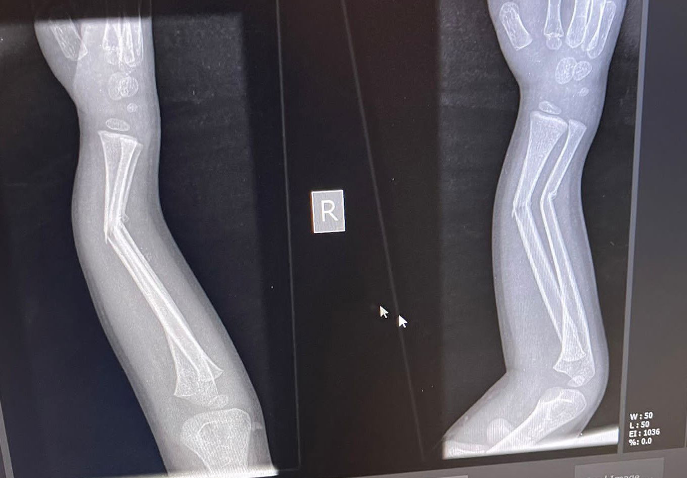 עשרות ילדים נפגעים מרכיבה מסוכנת