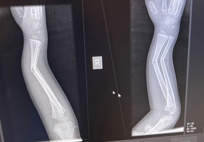 עשרות ילדים נפגעים מרכיבה מסוכנת