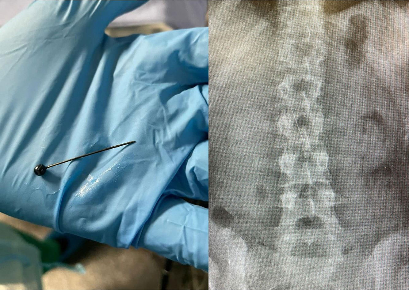 הסיכה שבלעה הילדה