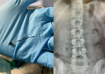 הסיכה שבלעה הילדה