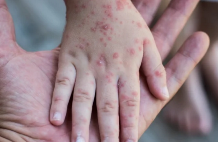 אבעבועות הקוף: משרד הבריאות ימליץ להתחסן