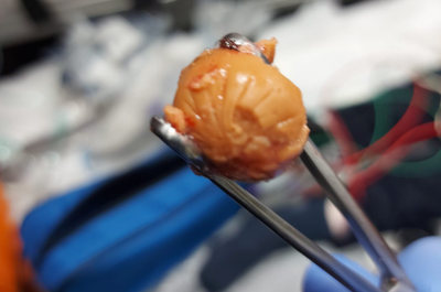 בני ברק: ילד  נחנק מנקניקיה ופונה במצב קשה ויציב