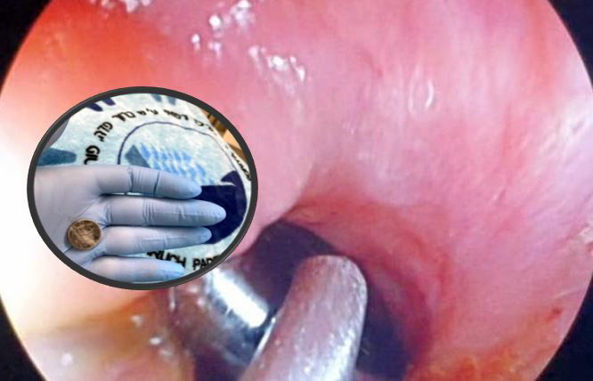 סוללה בתוך הוושט - ולאחר שהוצאה | ארכיון