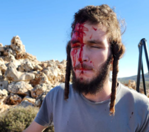 ערבים יידו אבנים ופצעו יהודים; השוטרים עסוקים בפינוי