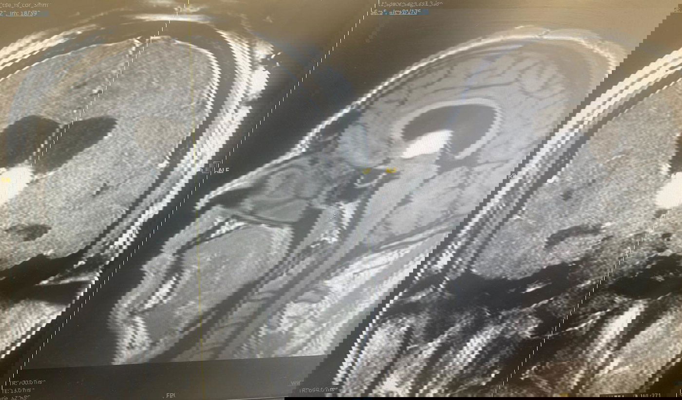 הגידול שהתגלה