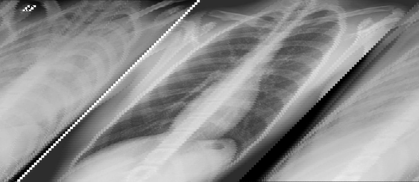 מימין צילום ריאות תקין. משמאל: צילום ריאותיו של הנער