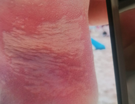 עקיצת המדוזה